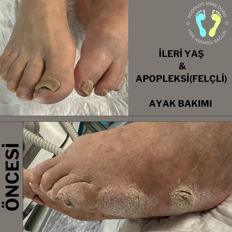 İleri Yaş APOPLEKSİ (Felçli) Hasta Nasır Tedavisi