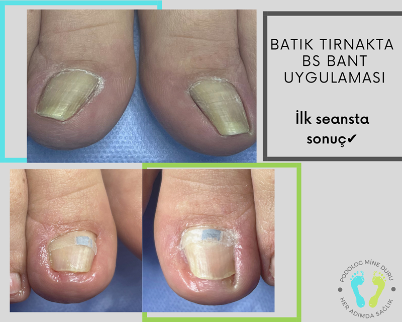 Batık Tırnak BS Bant Uygulaması.