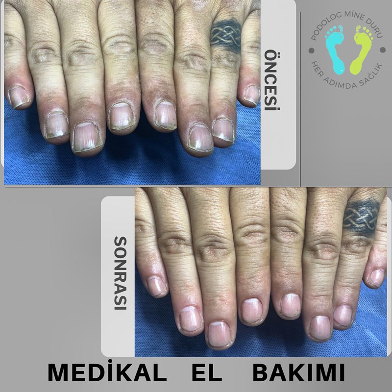 Medikal El Bakımı