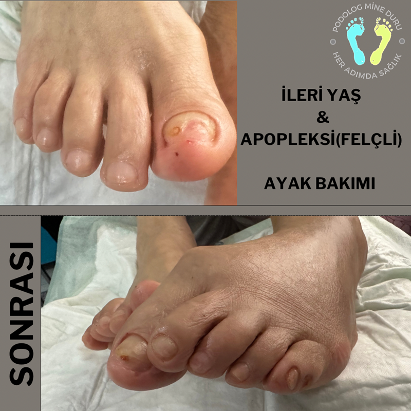 İleri yaş APOPLEKSİ (Felçli)Hasta Ayak Bakımı