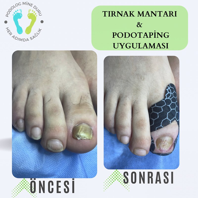 Tırnak Mantarı Podotaping Uygulaması